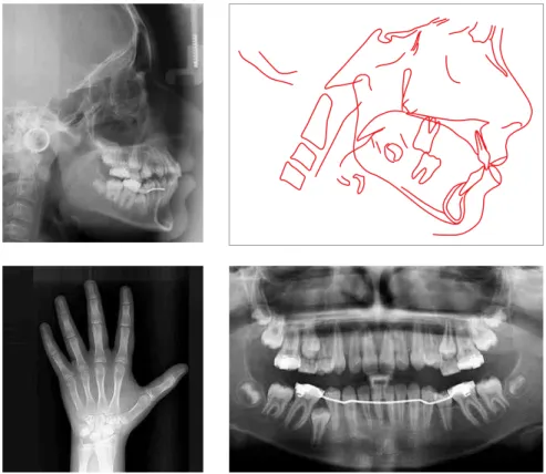 Figure 13 - Radiographs and cephalometric trac- trac-ing after orthopedic treatment.