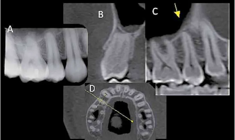 Figure 4 - Periapical radiograph of a maxillary right second premolar shows score 2 according to Levander and Malmgren system (A)