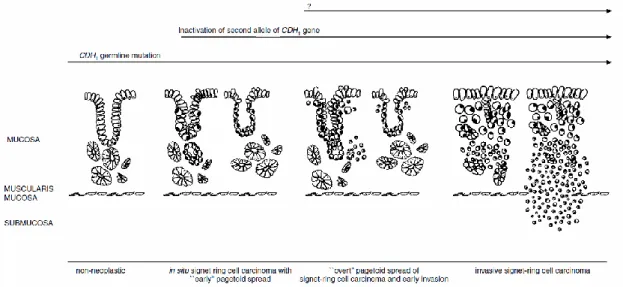 Figure 3 - Proposed model for early development of diffuse gastric cancer in CDH1 mutation carriers