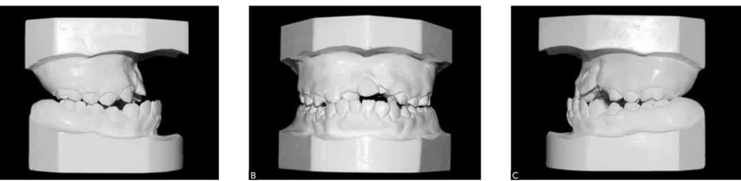 Table 3 - Evaluation index of the occlusal characteristics using casts (inter-arch relationship) in individuals with unilateral CLP