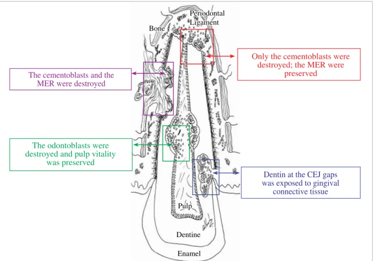 Figure 2 - Destruction or local exposure of the four protective structures of the tooth are the initial phenomena of the four diferent types of resorption pro- pro-cesses leading directly to its cause, treatment plan and prognosis in each clinical case, as