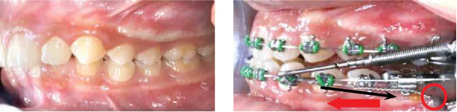 Figure 11 - A Class II malocclusion treated with the ixed functional appliance and micro-implants: A forward movement of mandible by the ixed functional  appliances (red arrow) and retraction of the mandibular dentition using the micro-implants (black arro