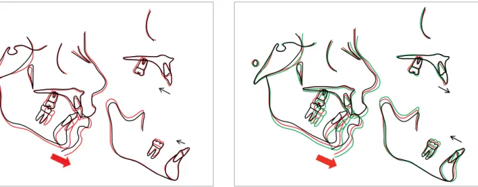 Figure 13 - Superimposition of the tracing generated from the radiographs  taken before (black) and after (red) the functional appliance therapy for  twelve months.