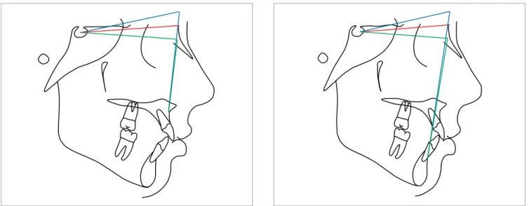 Figure 3 - A relatively high Sella position makes maxilla and mandible more protrusive.