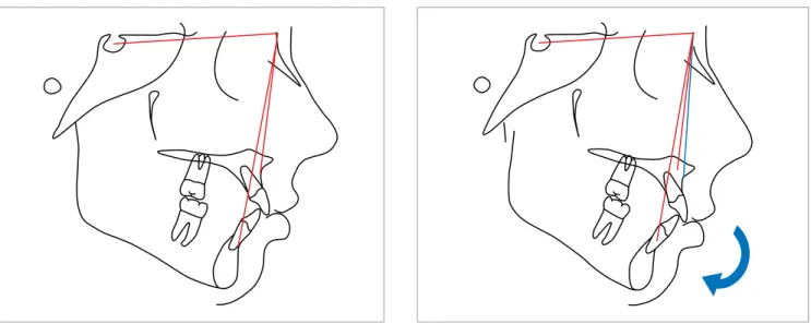 Figure 4 - A clockwise rotation of maxillomandibular complex creates more of a Class II relationship