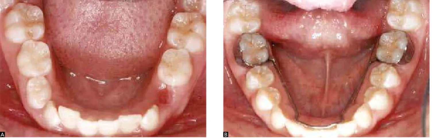 Figure 1 - A) T 1  : mixed dentition, previously to installation of the lingual arch. B) T 2 : young permanent dentition with lingual arch installed.