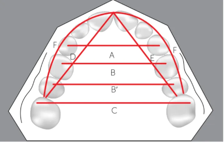 Figure 1 - Little Irregularity Index (modiied for the upper arch) = A+B+C+D+E. Figure 2 - Variables studied on dental casts: A, intercanine width; B, inter-irst- inter-irst-premolar width; B’, inter-second-inter-irst-premolar width; C, intermolar width; D 
