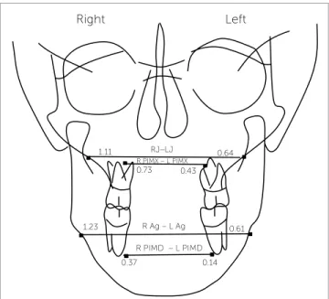 Figure 5 - Individual annual changes in transverse growth on the region of  posterior implants of the maxilla during bionator therapy.