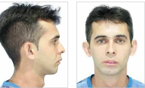 Figure 1 and 2 - Frontal and right side photo- photo-graph of long face pattern patient