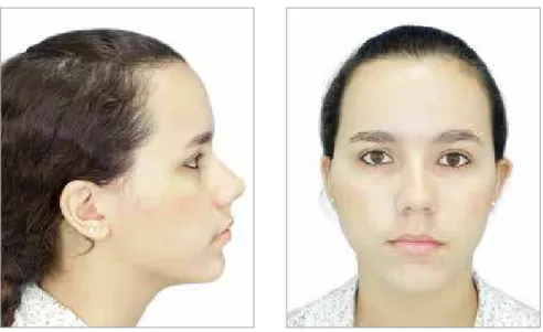 Figure 3 and 4 - Right side and frontal photo- photo-graph of Pattern I patient.