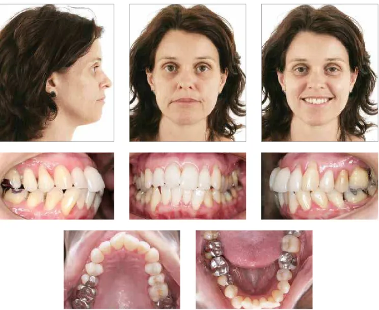 Figure 1 - Initial facial and intraoral photographs.