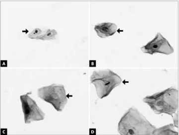 Figure 1 - Evaluation of the nuclear alterations in the cone beam com- com-puterized tomography sequence (CBCT) or radiographic exposure (400x  magnification, Feulgen/Fast Green stain): cells (A) micronucleated  (ar-row) and normal, (B) karyorrhexis (ar(ar