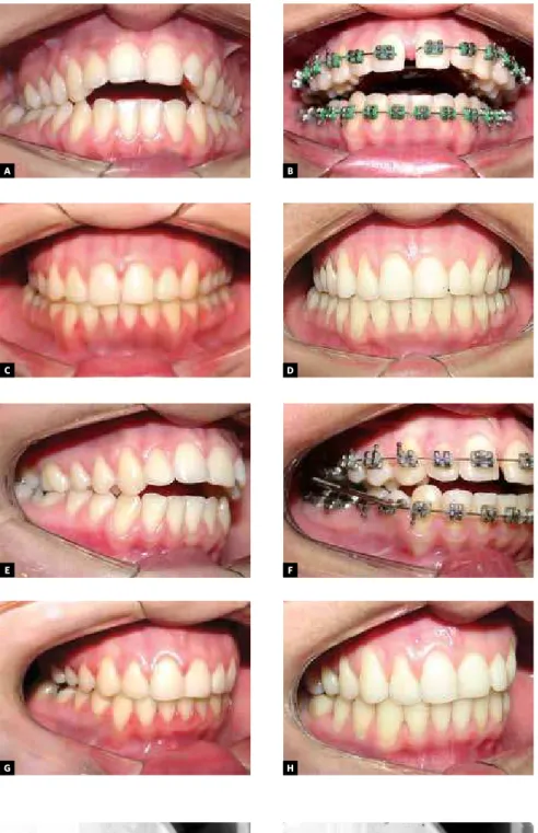 Figure 1 - Baseline intraoral images of a 19.5-year- 19.5-year-old patient with a Class II division 1 malocclusion (A,  E) treated with a rapid palatal expander and a Herbst  appliance (B,F) at 2 years and 11 months  (C,  G)  completed with speech therapy;