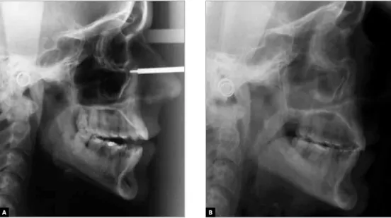 Figure 4 - Baseline cephalogram at 31 years of age shows open bite (A). At treatment completion, open bite was  corrected without surgery (B), with extraction of teeth 18, 28, 36 and 46; 2 years and 10 months after treatment.
