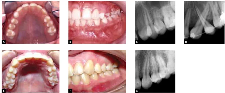 Figure 5 - Baseline intraoral view of an 11.5-year-old patient with Class I malocclusion and maxillary left canine-irst pre- pre-molar transposition (A, B, C); treatment with ixed straight wire appliance and reversal of transposed roots (D); at 2 years  an