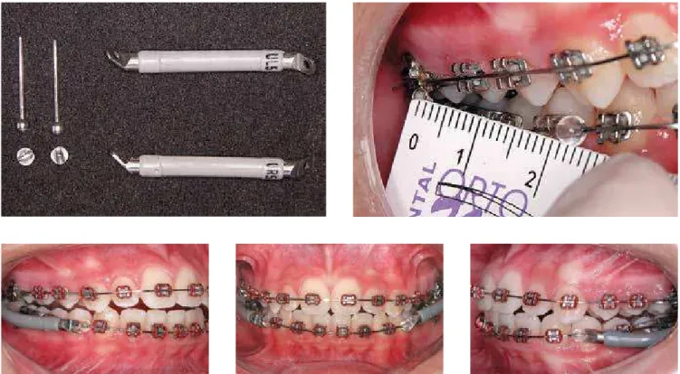 Figure 3 - After alignment and leveling with ixed appliances – Installation of Jasper Jumper and mandibular advancement.