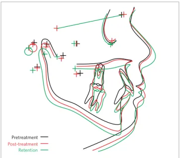 Table 1 -  Changes in cephalometric variables  during and after treatment.