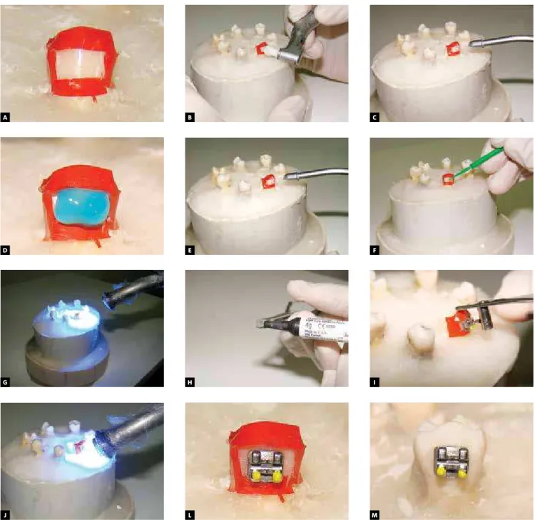Figure 2 - A) Setting the mask. B) Prophylaxis (10s each tooth). C) Rinsing and drying