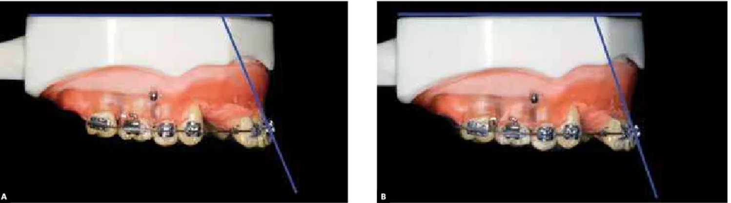 Figure 3 - A) Incisor position before retraction with chain elastics and a 6-mm hook and mini-implant; B) retracted incisors.