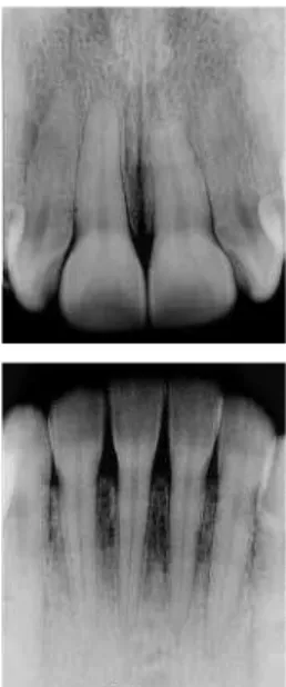 Figure 3 - Initial panoramic and periapical radiographs. 