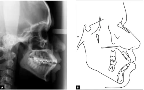 Figure 4 - Initial cephalometric proile radiograph (A) and cephalometric tracing (B).