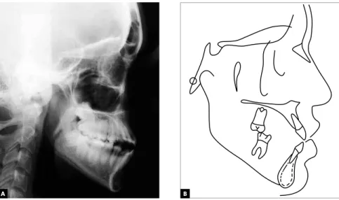 Figure 12 - Initial panoramic radiograph. Figure 13 - Initial lateral cephalometric radiograph (A) and cephalometric tracing (B)