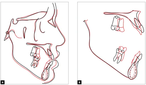 Figure 18 - Total (A) and partial (B) superimpositions of initial (black) and inal (red) cephalometric tracings