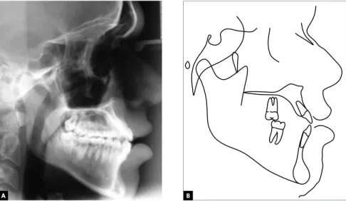 Figure 20 - Initial panoramic radiograph. Figure 21 - Initial lateral cephalometric radiograph (A) and tracing (B)