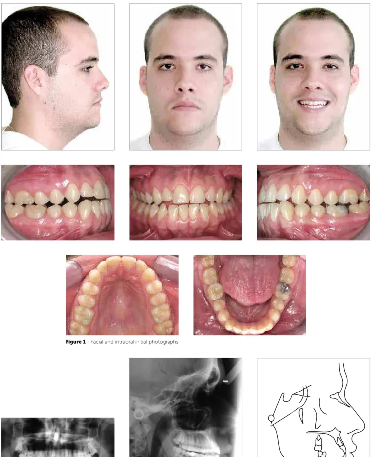 Figure 1 - Facial and intraoral initial photographs. 