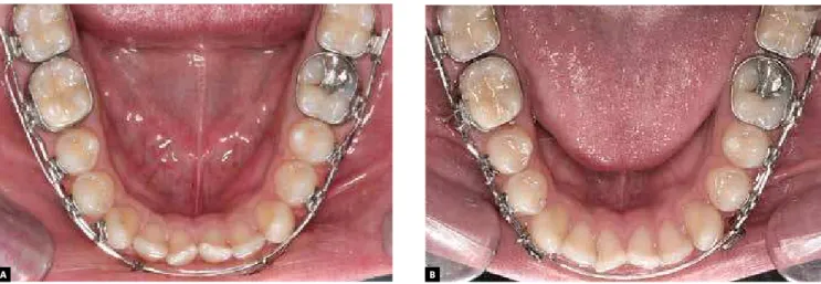 Figure 6 - A) Beginning of Class III mechanics. B) After 40 days, spaces between the upper teeth can be noticed.