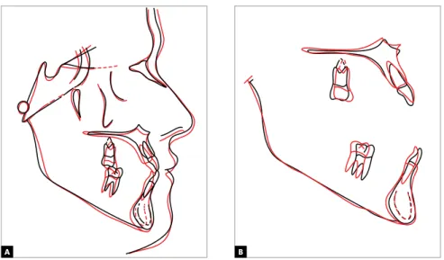 Figure 10 - Total (A) and partial (B) superimpositions of initial (black) and inal (red) cephalometric tracings