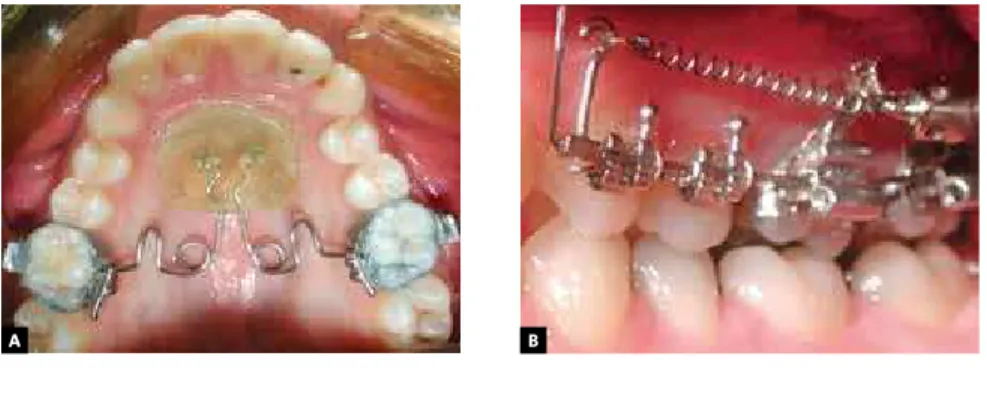 Figure 1 - A) - Pendulum appliance supported in  mini-implants. B) Zygomatic anchorage