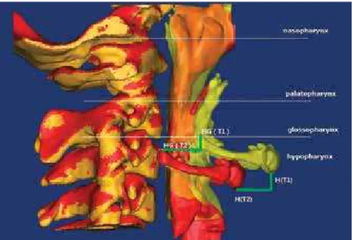 Figure 2 - 3D Model of four parts of pharynx, hyoid and cervical vertebrae,  showing the distance between models in T 1  and T 2 
