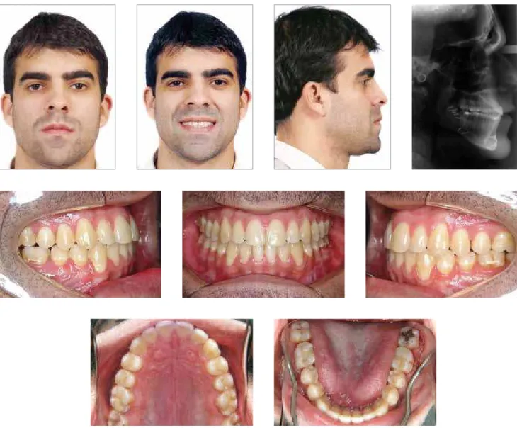 Figure 5C - Combined orthodontic and surgical treatment with minimal facial esthetic changes: Final  photographs.