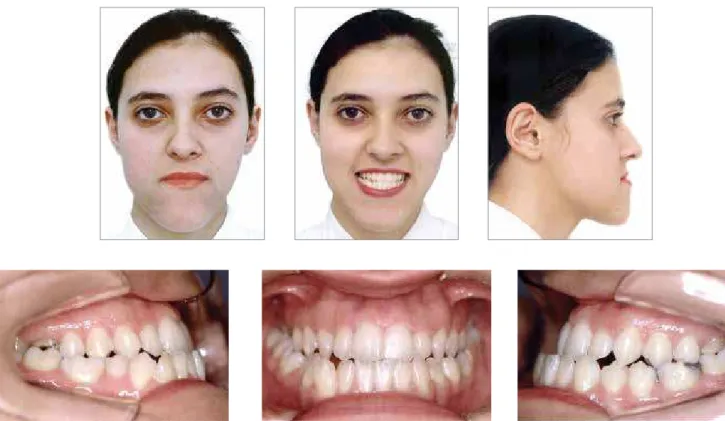 Figure 5D - Combined orthodontic and surgical treatment with signiicant facial esthetic changes: Initial photographs.
