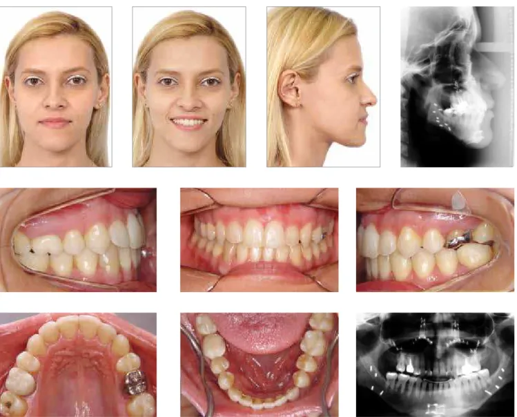 Figure 5F - Combined orthodontic and surgical treatment with signiicant facial esthetic changes: Final photographs.