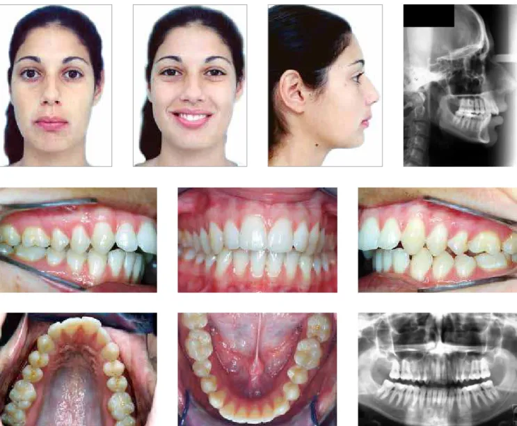 Figure 6A - Combined orthodontic and surgical treatment of Class II dentofacial deformity by two separate surgical procedures: Initial photographs.