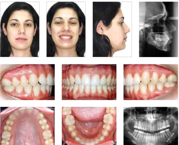 Figure 6C - Treatment of Class II dentofacial deformity by two separate surgical procedures: Final photographs after mandibular advancement.