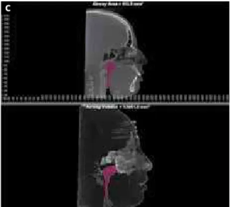 Figure 2 - Indications for the use of CBCT: Evaluation of alveolar and cortical bone thickness (A);  