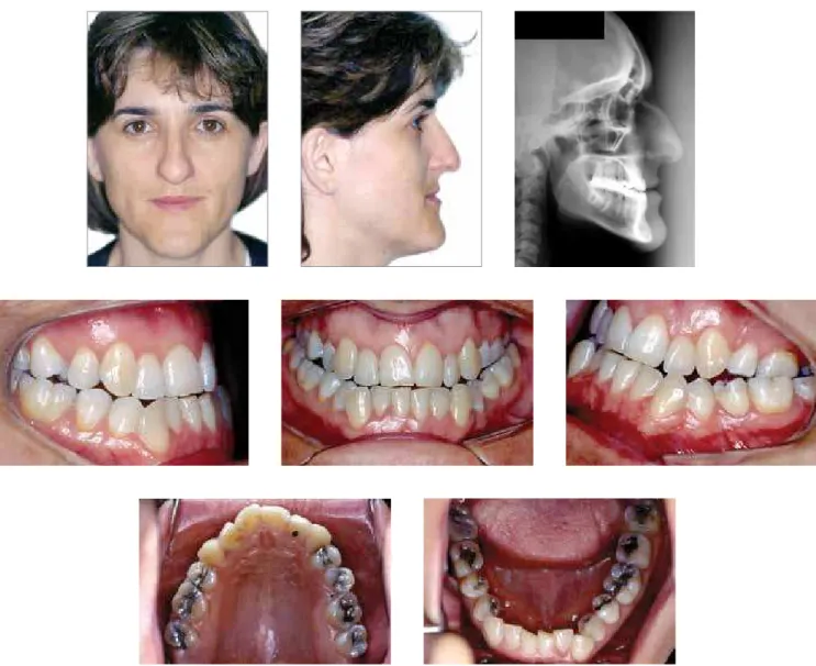 Figure 4B - Combined orthodontic and surgical treatment: Presurgical photographs.