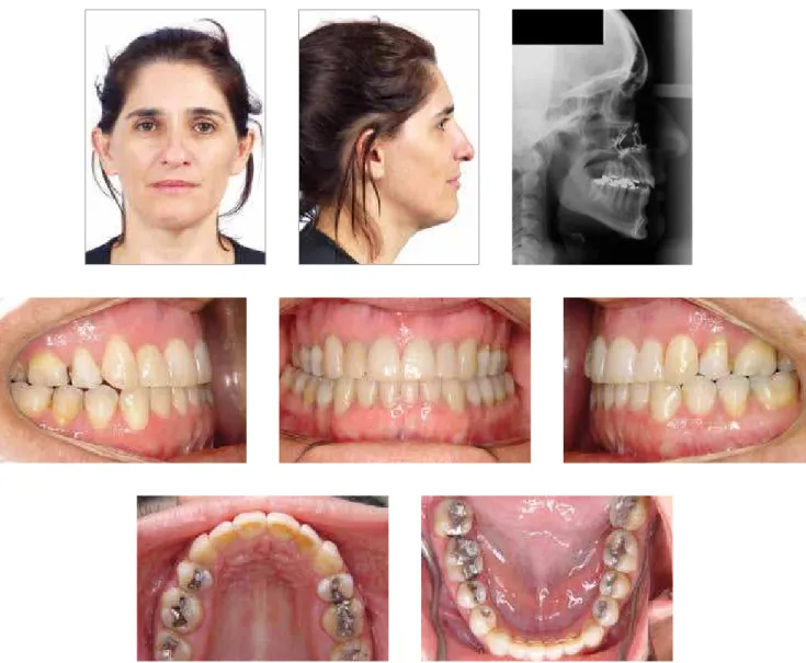 Figure 4C - Combined orthodontic and surgical treatment: Final photographs.