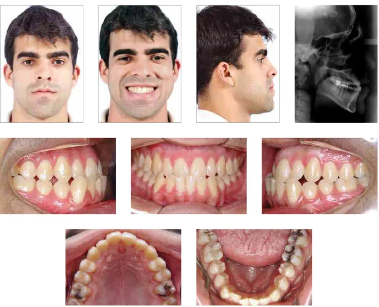 Figure 5A - Combined orthodontic and surgical treatment with minimal facial esthetic changes: Initial  photographs.