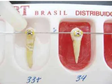 Figure 1 - Tooth / bracket set ixation to the plastic matrix.