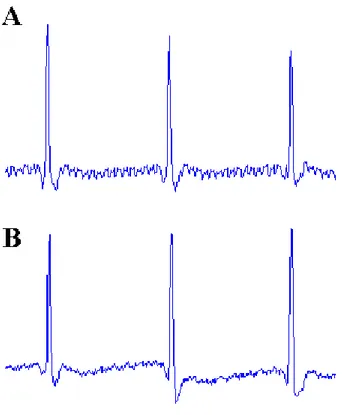 Figura 18 - Sinais de ECG captados durante benchmarking a partir do sistema comercial (A) e do sistema  desenvolvido (B)