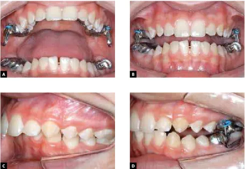 Figure 1 - A) MARA appliance in place with its components. B) The loops on the crowns create occlusal  interference and hinder Class II occlusion