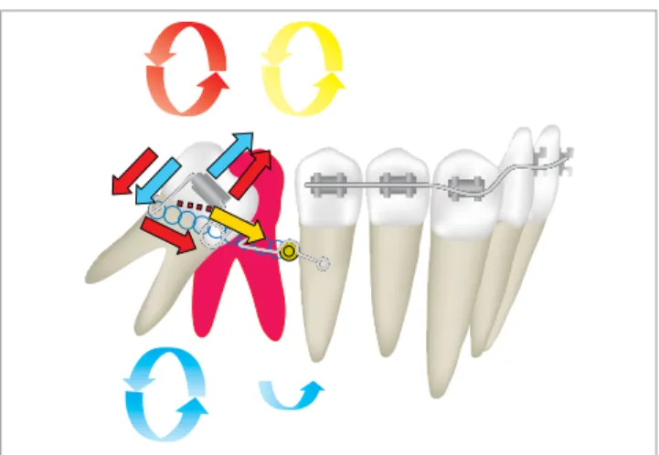 Figure 3 - Diagram demonstrating activation of the spring to obtain upright- upright-ing with mesial movement of the root.