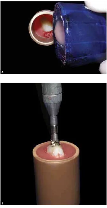 Figure 1 -  Sequence of specimen confection.  A ) Tooth positioning,  B ) Pressure exerted on the bracket to standardize the thickness of the  material,  C ) specimens finished.