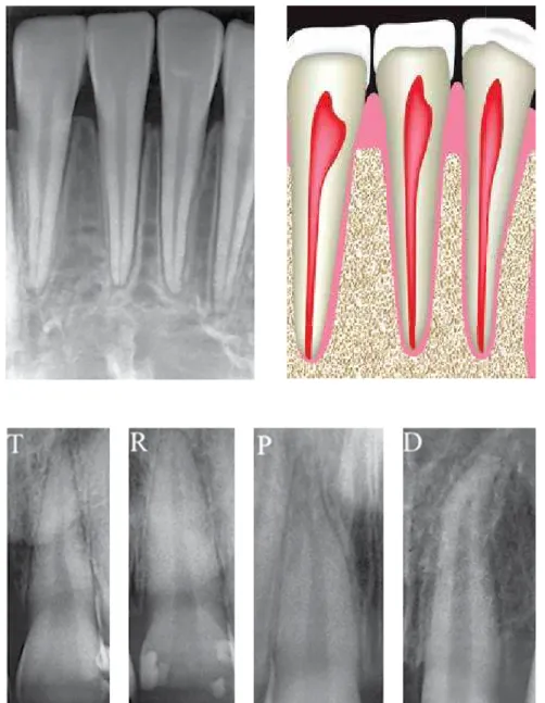 Figure 2 - Alveolar crest bone morphology.