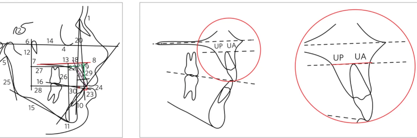 Figure 5 - Cephalometric variables used. Figure 6 - UA+UP distance, parallel to the palatal plane (ANS-PNS).
