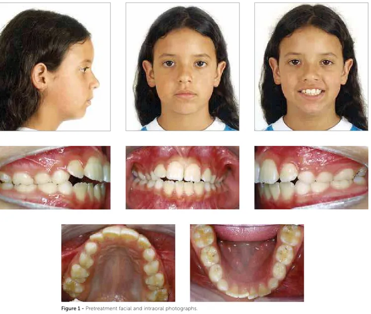 Figure 1 - Pretreatment facial and intraoral photographs.